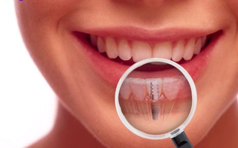 dentalimplants